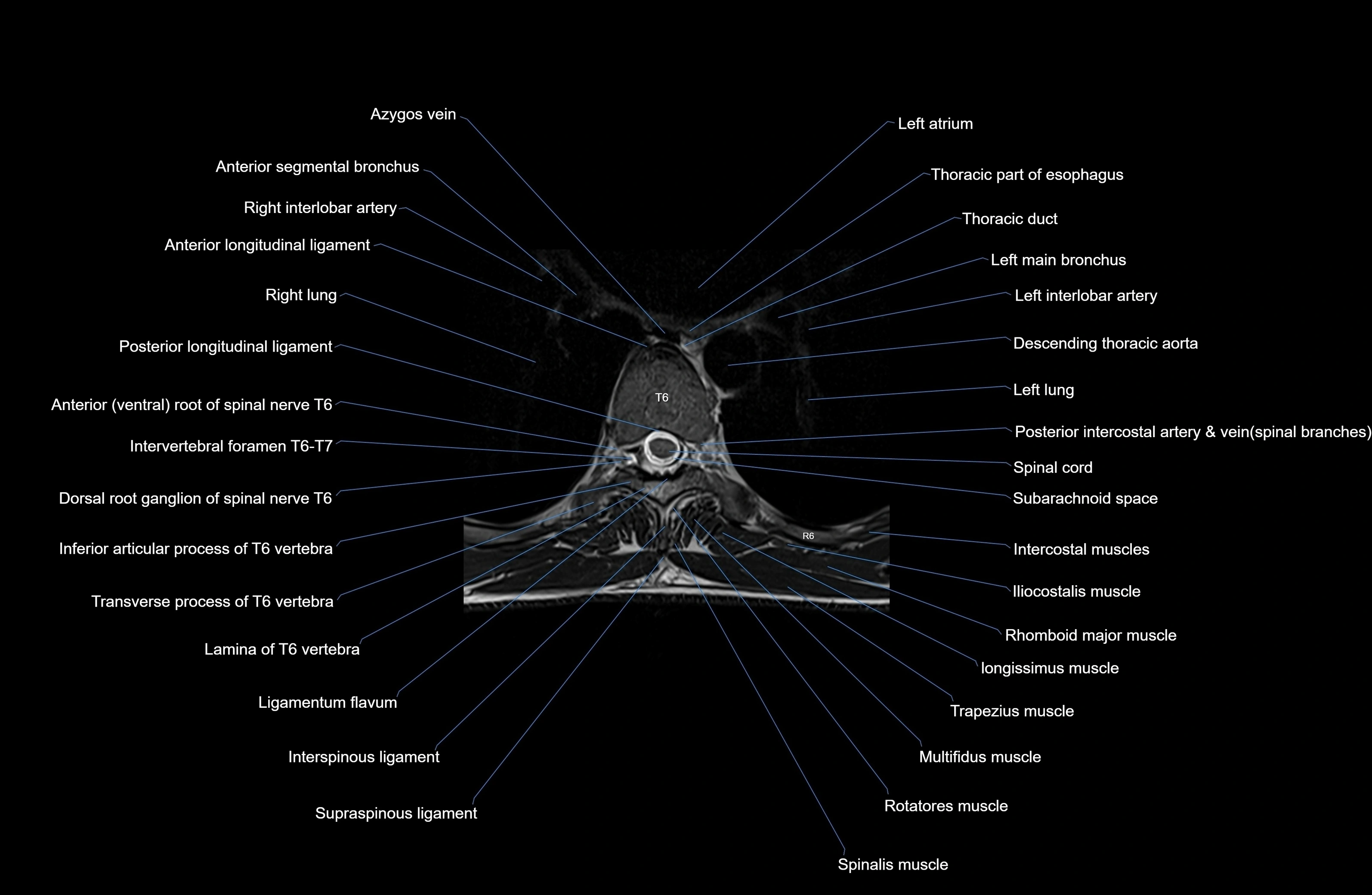 MRI thoracic spine axial  cross sectional anatomy 3T radiology  image-img-00001-00040.webp